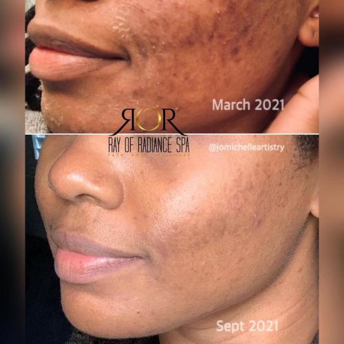 Chemical Peels 1