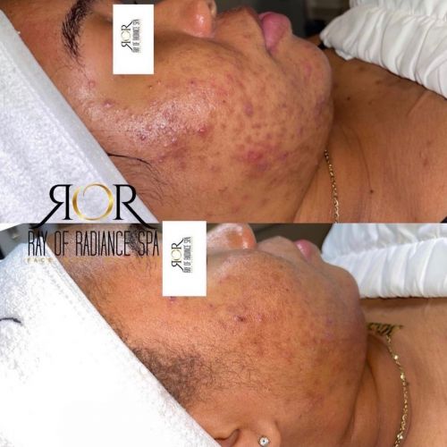 Chemical Peels 10