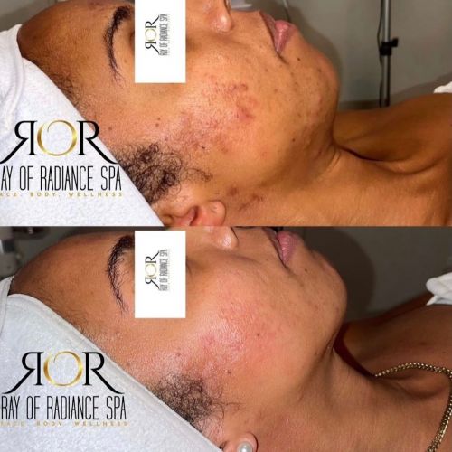 Chemical Peels 11
