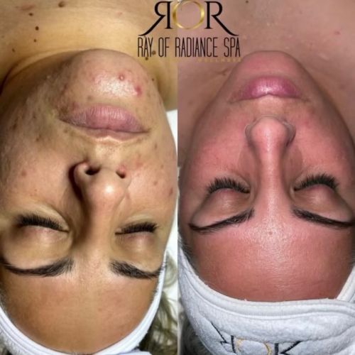 Chemical Peels 14