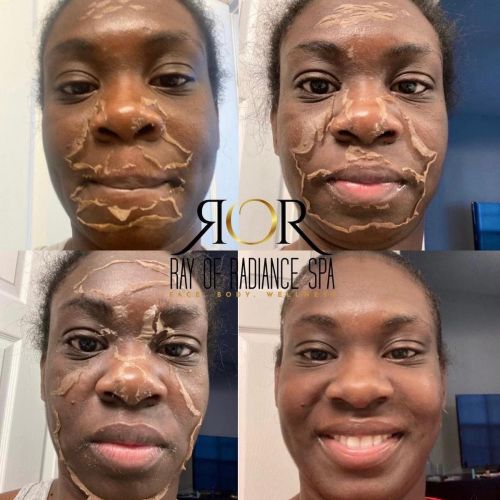 Chemical Peels 15