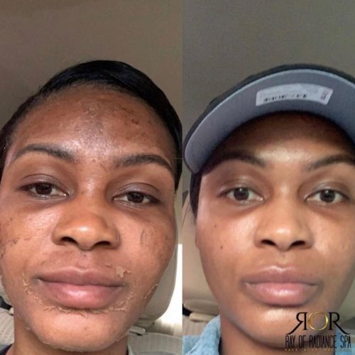 Chemical Peels 16