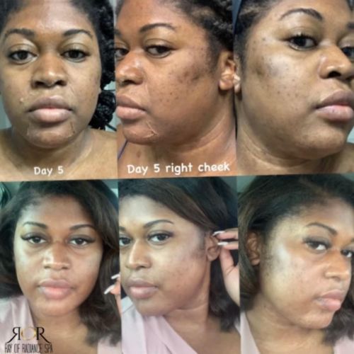 Chemical Peels 2