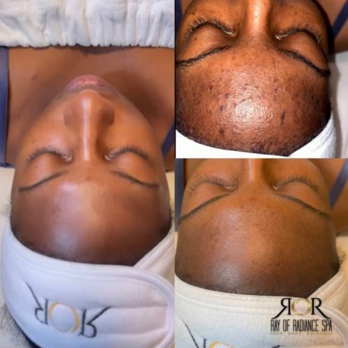 Chemical Peels 3