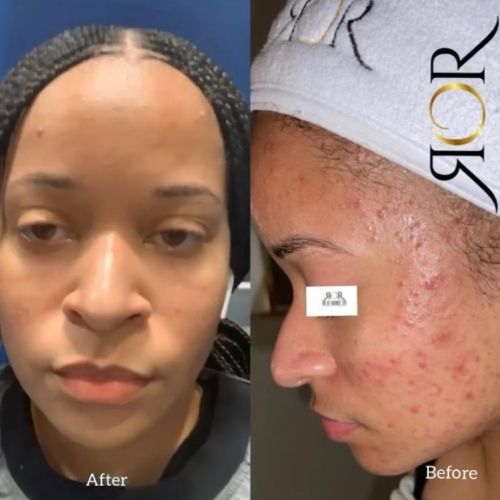 Chemical Peels 4