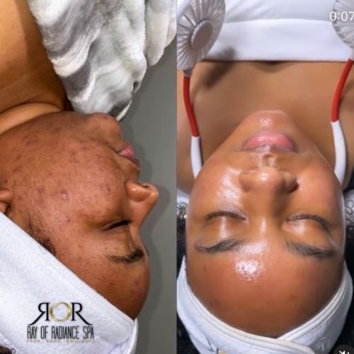 Chemical Peels 6