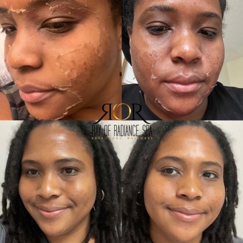 Chemical Peels 7