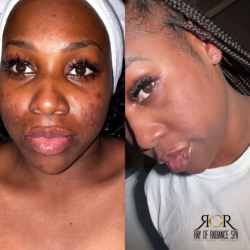 Chemical Peels 8