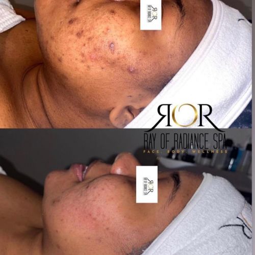 Chemical Peels 9