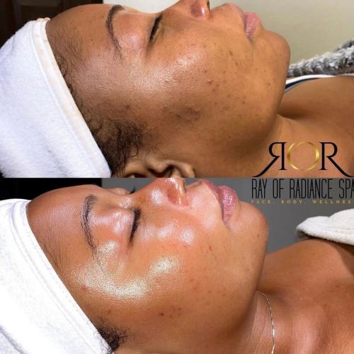 Facial Treatment 4