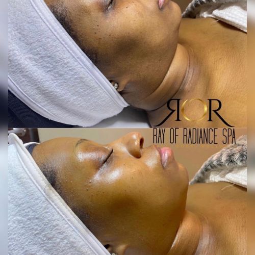 Facial Treatment 5