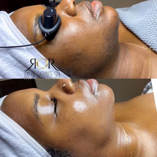 Facial Treatment 8