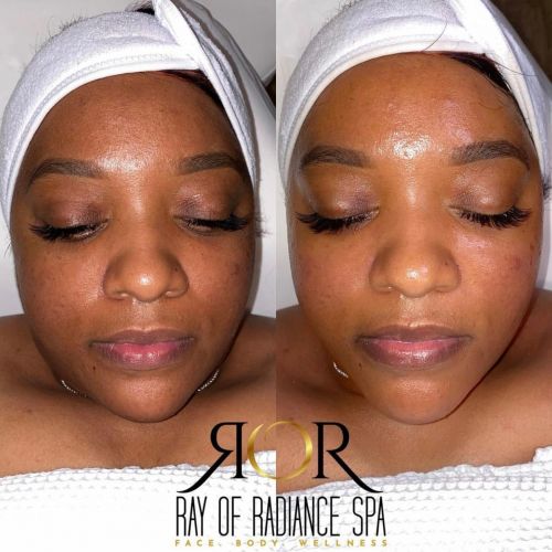Facial Treatment 9