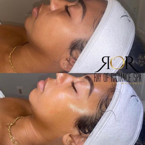 Facial Treatment 10