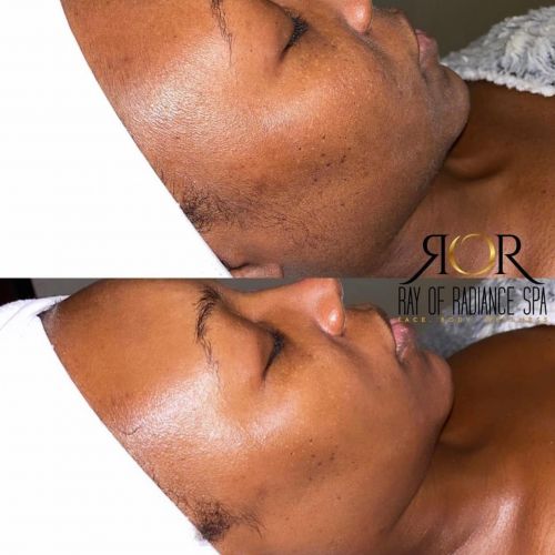 Facial Treatment 11
