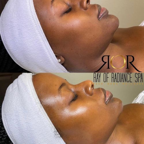 Facial Treatment 12